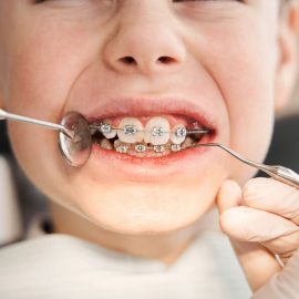 Apparecchi ortodontici per bambini